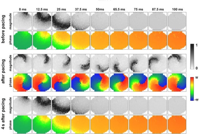 Novel high-dense microelectrode array based multimodal bioelectronic monitoring system for cardiac arrhythmia re-entry analysis